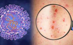 Tuyên truyền phòng chống bệnh đậu mùa khỉ